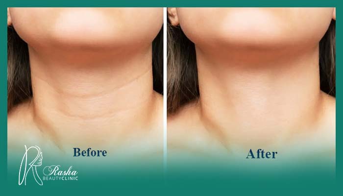 چرا به گردن پروفایلو بزنیم؟