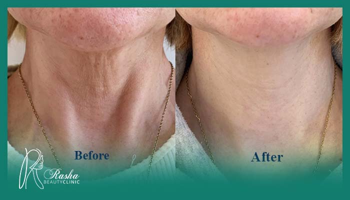 مزیت جوانسازی و رفع خطوط گردن با پروفایلو