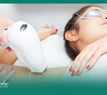 لیزر موی زائد