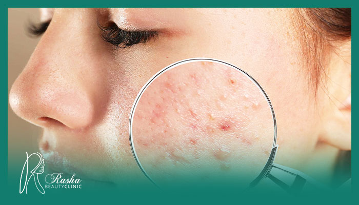 رفع جای جوش|رفع لک و آکنه