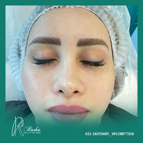 جوانسازی پوست با ترمیا