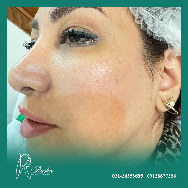 جوانسازی پوست با ترمیا