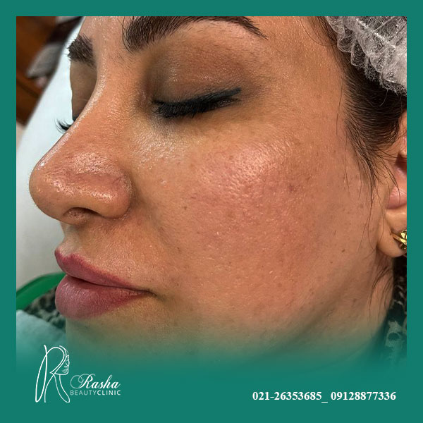 جوانسازی پوست با ترمیا